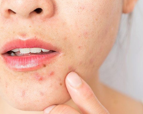 Hormones and Skin Health: How PCOS Influences Acne and What You Can Do About It?