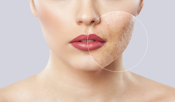 Transform Your Skin: Effective Methods to Treat Acne Scars